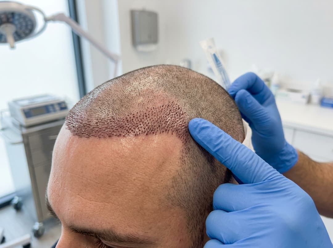 Hair transplant procedure